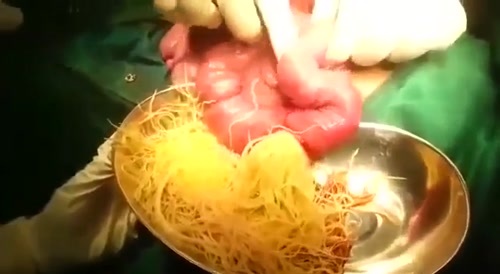 Worms Make Surgeon Giddy