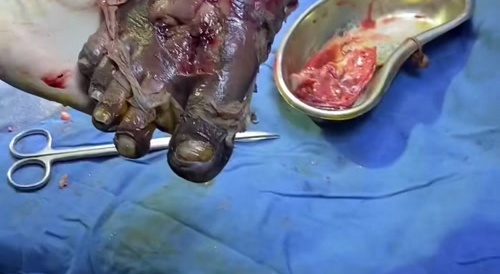 Diabetic Foot is Beyond Repair - Xtreme Gore