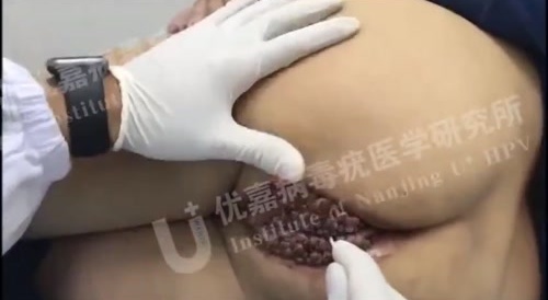 Anal Warts on a Hot Girl - gross!