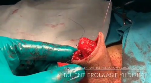 Penis Cancer Surgery - graphic content