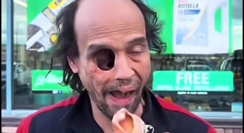 Crazy Man Has an Empty Eye Socket