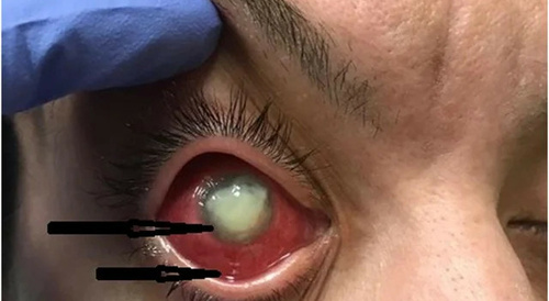 Cocaine Eye