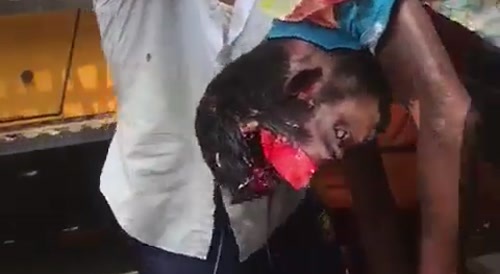 Man's Head Flattened By Tractor