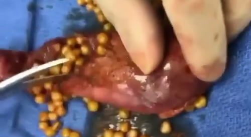 Gallstones anyone?