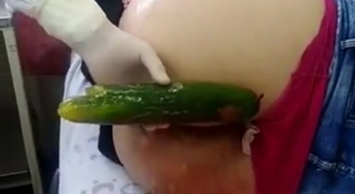 Woman has Huge Cucumber Removed from her Butthole - gross!