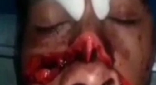 Extreme injured