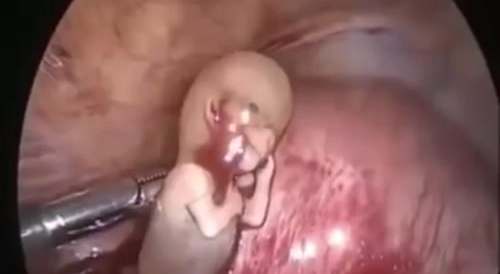 Abortion fetus