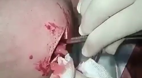 Draining of an abscess caused by drug injections.
