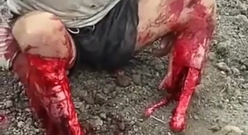 Bones exposed