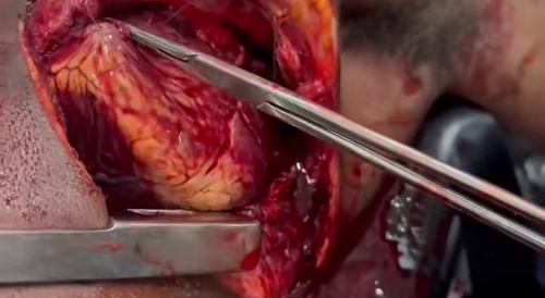 Emergency medical procedure (Open heart)