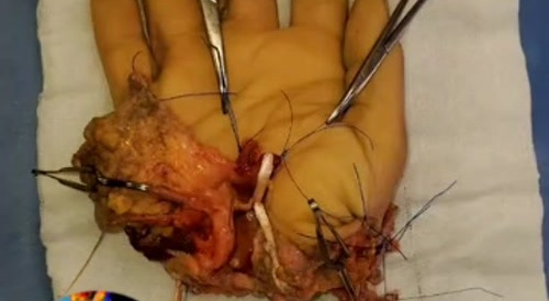 Hand restoration.