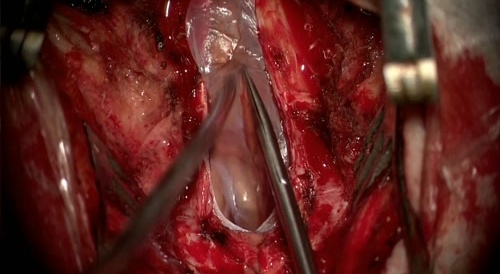 Arachnoid cyst removal.
