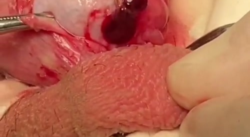 Hydatidectomy.