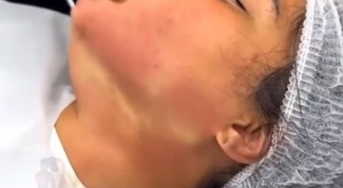 Neck Lipo