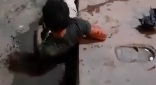 Man Removes Knife Dug Into His Skull