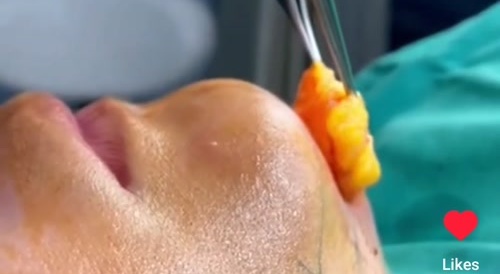 Thyroid gland removal