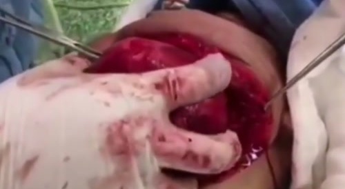 A giant tumor of the lower jaw