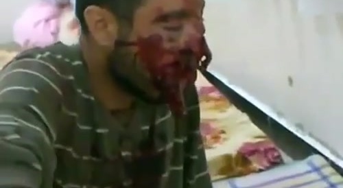 A Man Is Still Alive Even Though Half His Face Is Missing