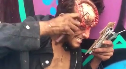 Psycho performs full thickness scalp excision on himself... !
