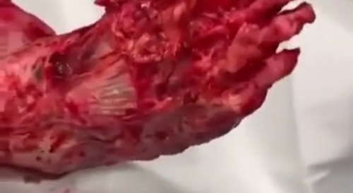 Man lives with a complete defleshed foot... !