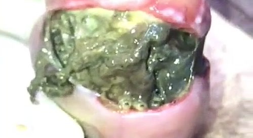 Maggot-infested acorn of a penis... !