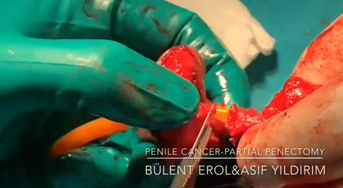 A penile cancer partial penectomy-circumcision... !