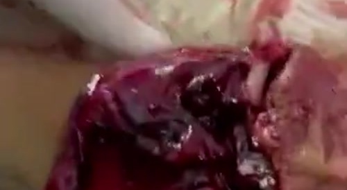 Someone's hand completely mauled in the meat grinder... !