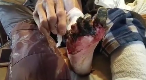 Necrosis to the foot : pull it off... !