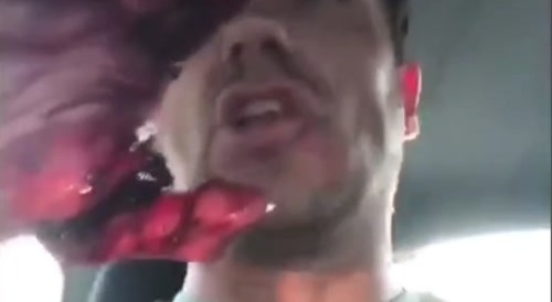 Dutchman messes up his thumb with fireworks... !