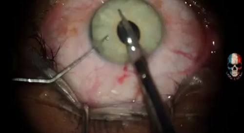 Eye Surgery