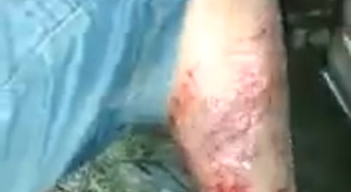 How they remove someone's undeserved tattoo... !