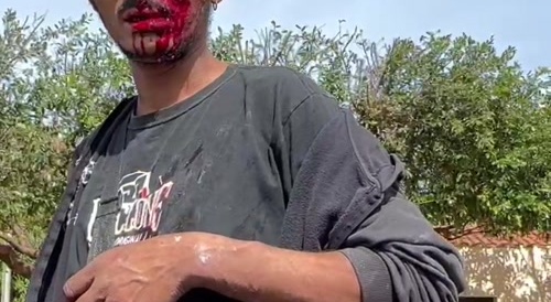 Man lost his eye after being stabbed...