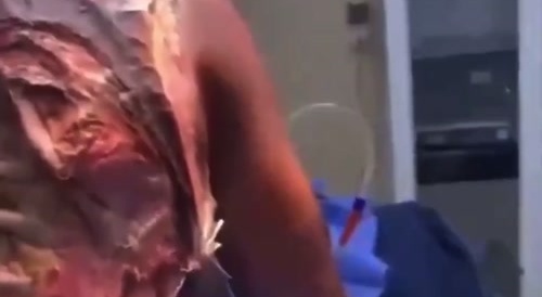 The most terrible injury of a man's back I ever saw... !