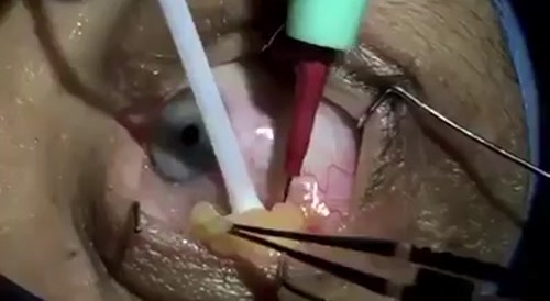 Eye Surgery
