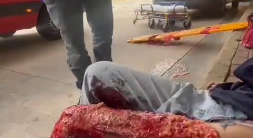 Sao Paulo woman suffers terrible leg injury which looks like minced meat...