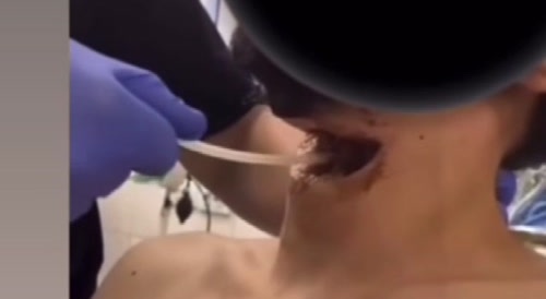 Ukrainian occupier survives Russian throat slit