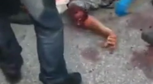 Arm fucked with motorcycle accident... !