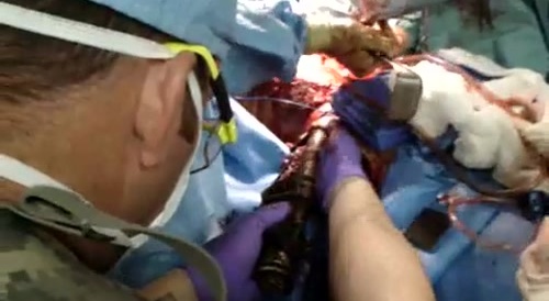 RPG projectile being removed from a soldier's body 2013