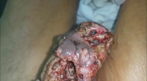 YUMMY UPCLOSE... : a penis infested with living maggots... !