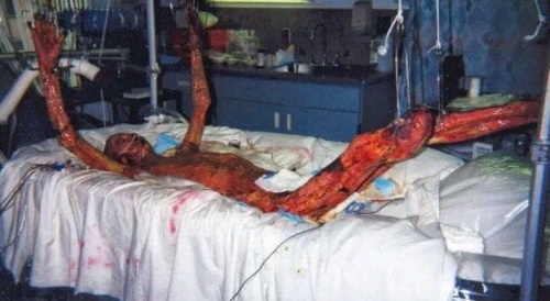 Hisashi Ouchi: the Tukaimura accident aftermath