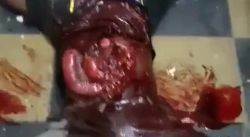 Clinging To Life: A Severely Injured Man With His stomach Torn Open And Organs Exposed