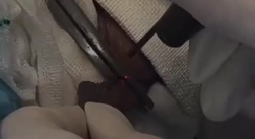 Labia Cut