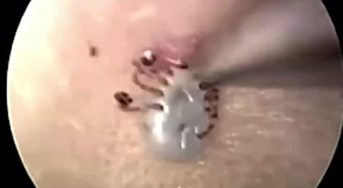 Tick stuck inside the ear is finally removed.