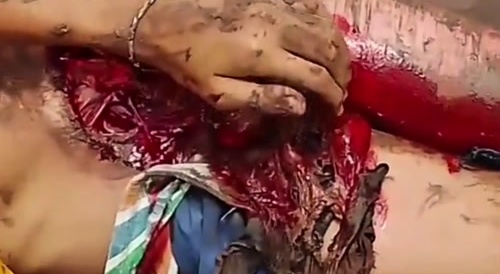 dude lost his genitalia