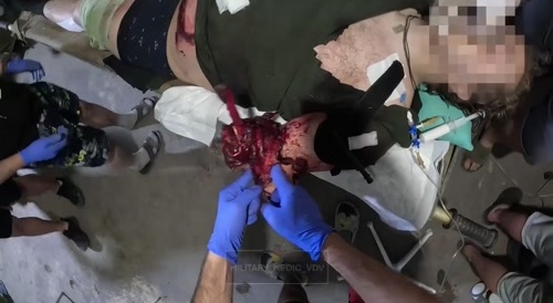 Treatment of a Russian VDV Officer Who Was Struck By a Mortar