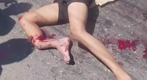 Motorcyclist did hurt his leg in a crash...