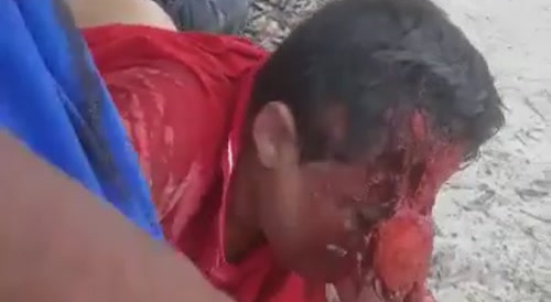 Horrific Accident Made His Forehead Fall Off