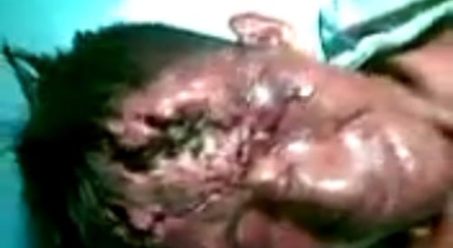 A man has worms in his head.