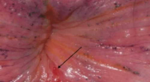 anal injury in a girl