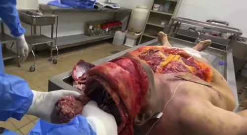 [AUTOPSY] Brain Removal and Examination